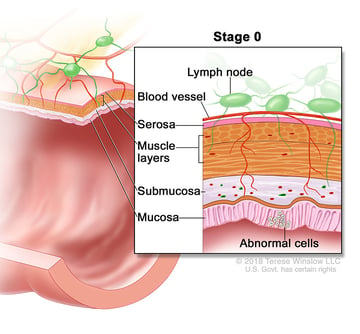 Stage 0 Colorectal Cancer medical illustration provided by compass oncology gi cancer doctors