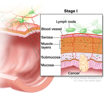 Stage 1 Colorectal Cancer medical illustration provided by compass oncology gi cancer doctors
