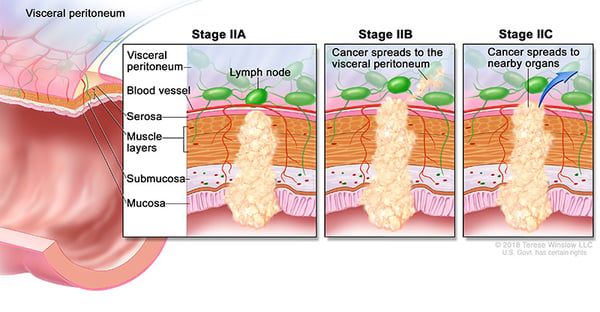 Stage 2, 2a, 2b, 2c Colorectal Cancer medical illustration provided by compass oncology gi cancer doctors