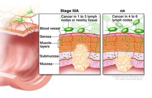 Stage 3a Colorectal Cancer medical illustration provided by compass oncology gi cancer doctors