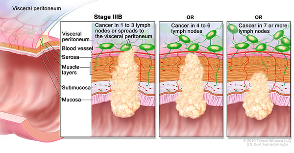 Stage 3b Colorectal Cancer medical illustration provided by compass oncology gi cancer doctors