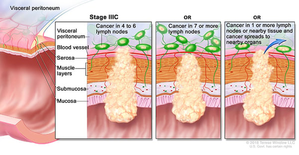 Stage 3c Colorectal Cancer medical illustration provided by compass oncology gi cancer doctors