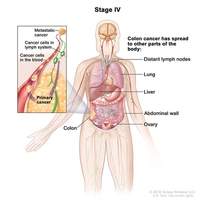 Stage 4 Colorectal Cancer medical illustration provided by compass oncology gi cancer doctors