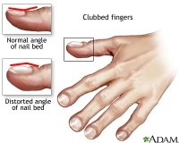 Clubbing of Finger nails and toenails is a sign of Lung Cancer