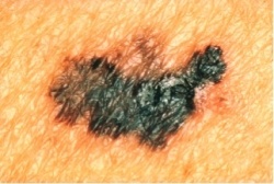 Skin cancer mole with non-uniform color