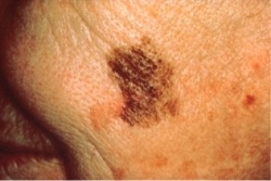 Skin cancer mole with a large border.