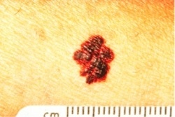 Skin cancer with a irregular border