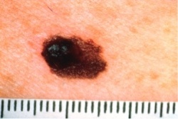 Skin Cancer - A of Asymmetrical Mole