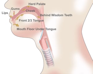 Oral-Cavity-Cancer