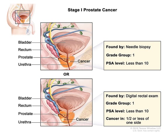 prostate-cancer-stage-1
