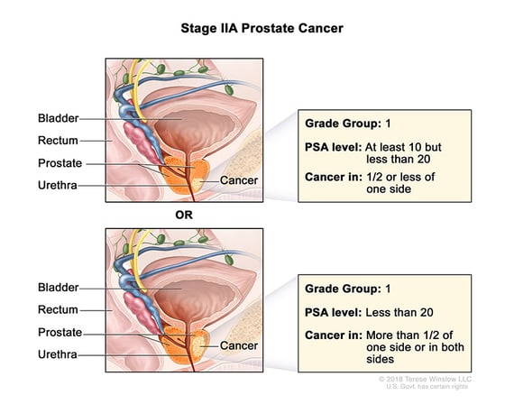 prostate-cancer-stage-2A