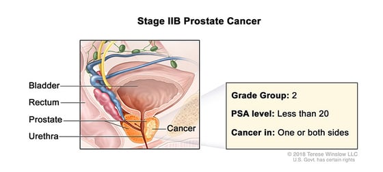 prostate-cancer-stage-2B