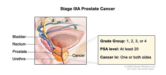 prostate-cancer-stage-3A