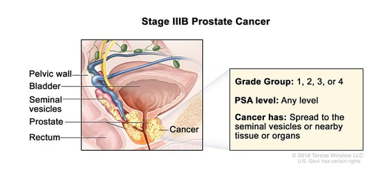 prostate-cancer-stage-3B
