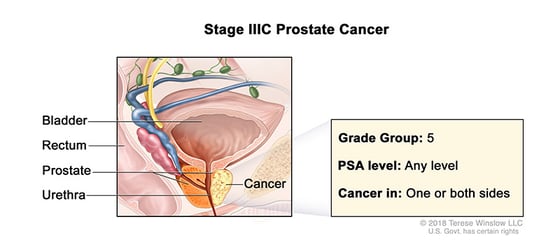 prostate-cancer-stage-3C