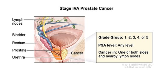 prostate-cancer-stage-4A