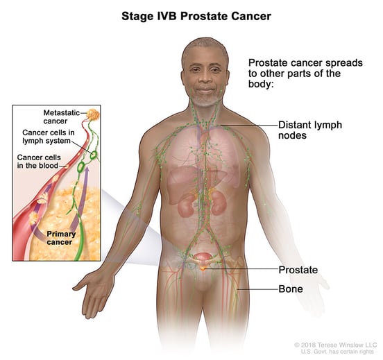 prostate-cancer-stage-4B
