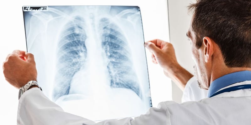 Are Lung Nodules Cancerous?