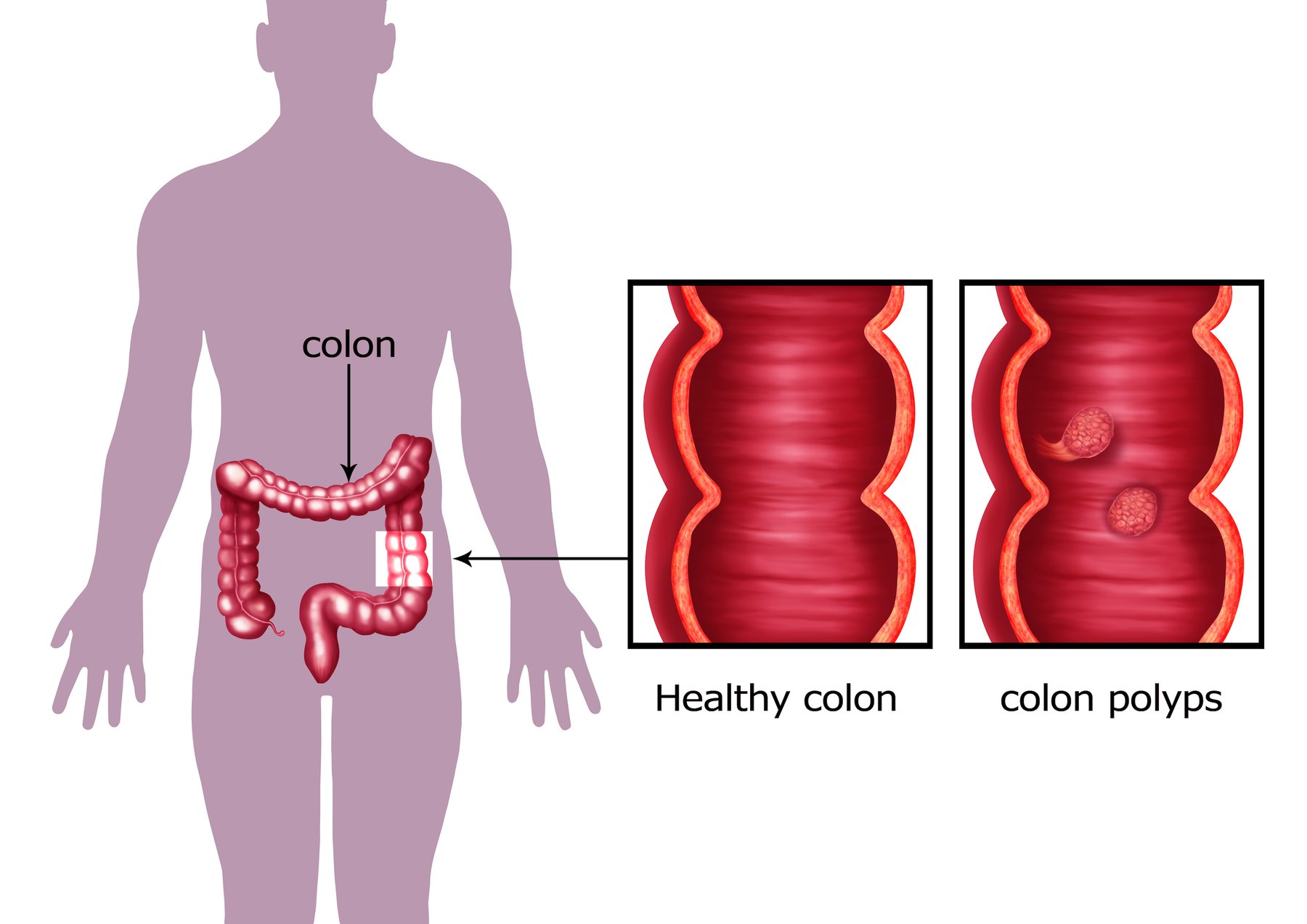 What Causes Colon Polyps? | Colorectal Cancer Specialists at Compass