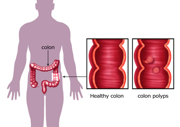 colon polyps can become colon cancer