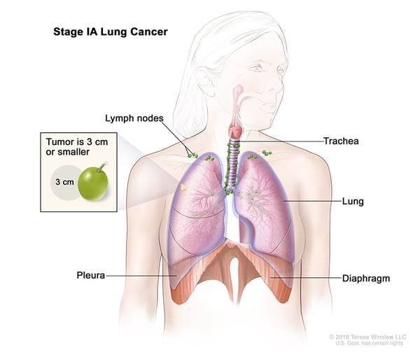 lung-carcinoma-stage1A