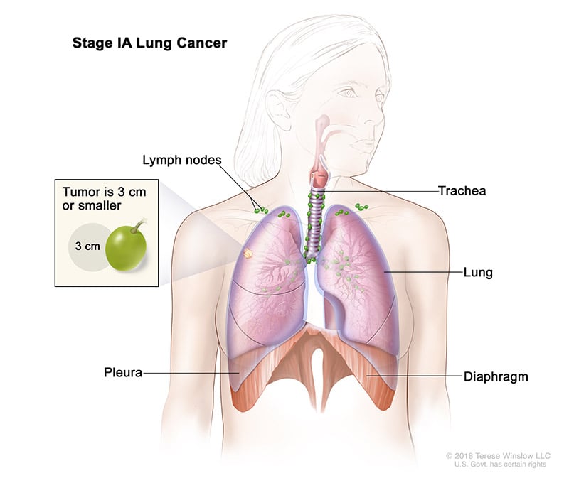 lung-carcinoma-stage1A