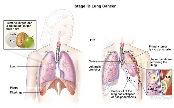 lung-carcinoma-stage1B