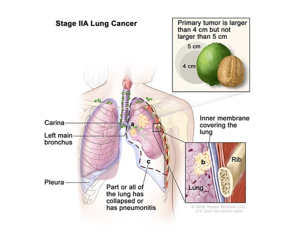 lung-carcinoma-stage2A