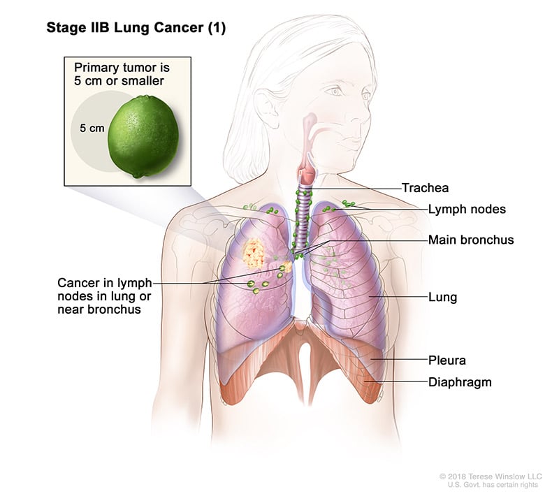 lung-carcinoma-stage2BPart1