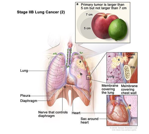 lung-carcinoma-stage2BPart2 (1)