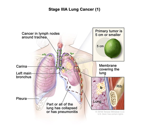 lung-carcinoma-stage3APart1