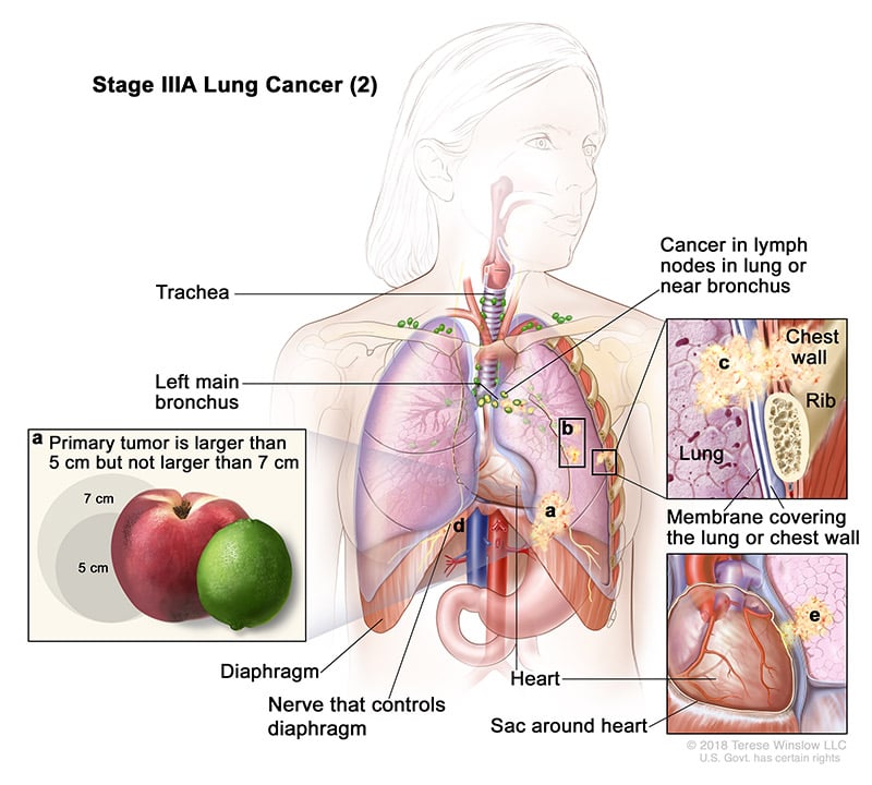 lung-carcinoma-stage3APart2