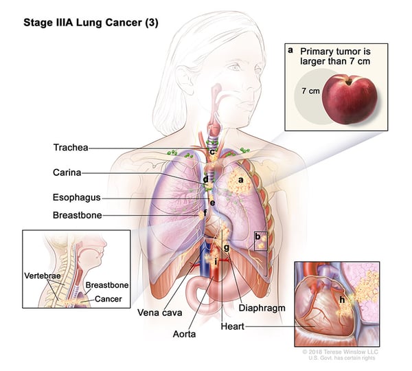 lung-carcinoma-stage3APart3