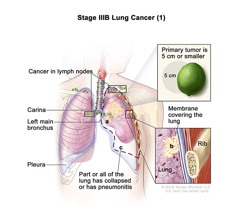 lung-carcinoma-stage3BPart1