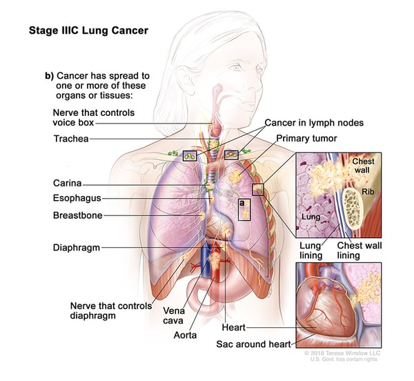lung-carcinoma-stage3C