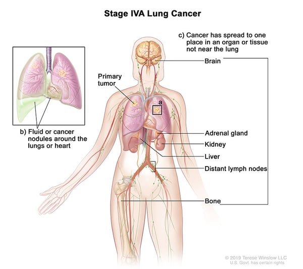 lung-carcinoma-stage4A