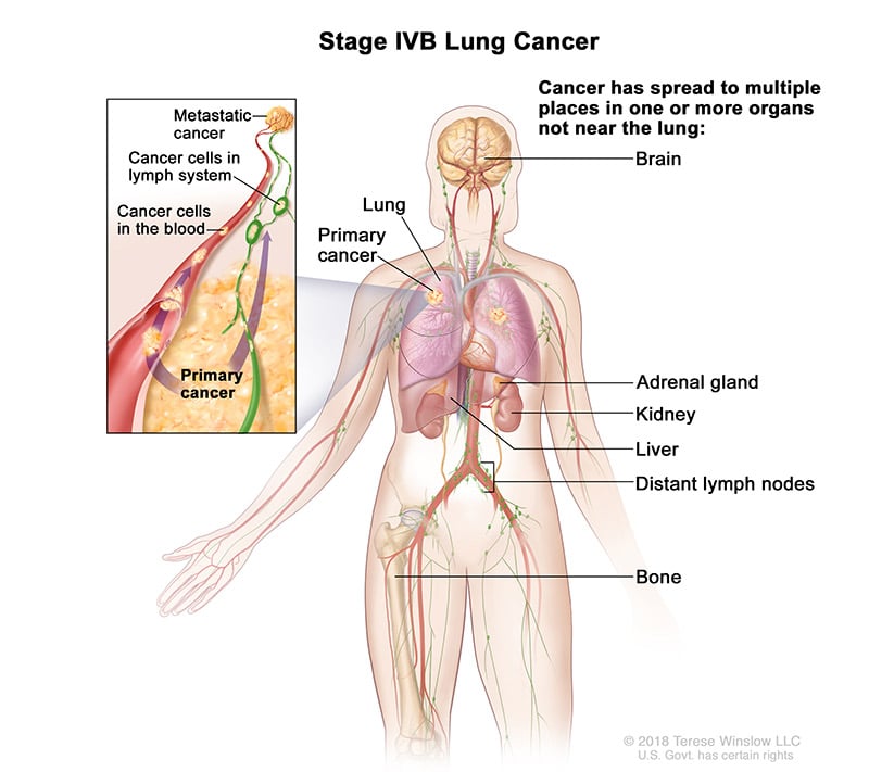 lung-carcinoma-stage4b