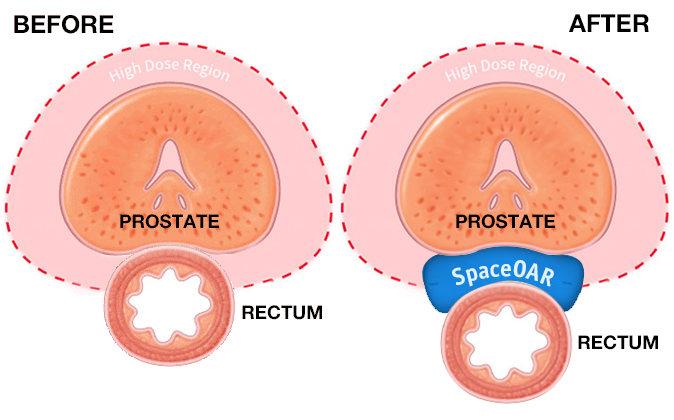 before and after spaceoar hydrogel for prostate cancer patients undergoing radiation therapy
