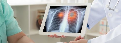 lung_cancer_types_compass_oncology